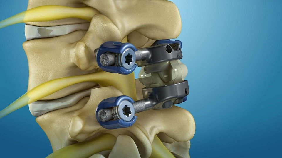 How Personalized Implants are Improving Spinal Fusion Success Rates 